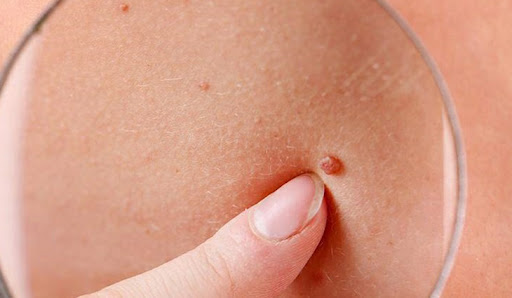 10 curiosidades sobre o câncer de pele